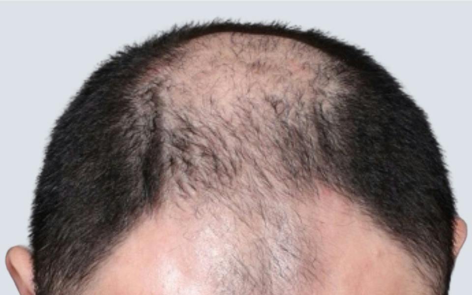 Hair Transplant Hawaii