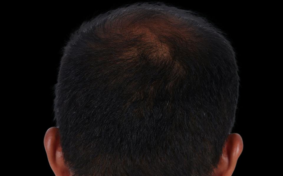 Hair Transplant Hawaii