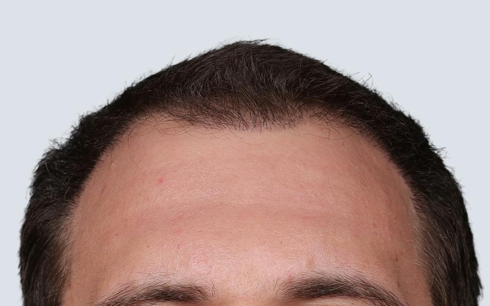Hair Transplant Hawaii