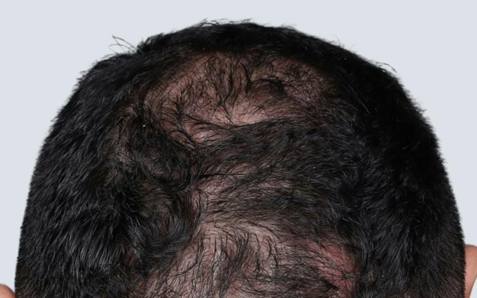Hair Transplant Hawaii