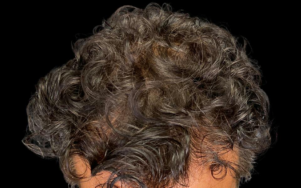 Hair Transplant Hawaii