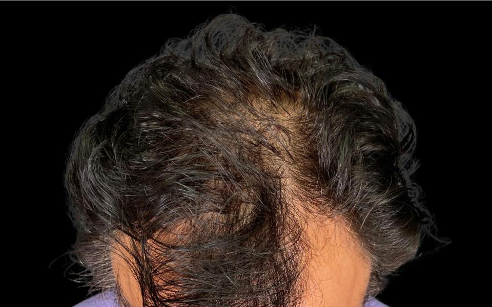 Hair Transplant Hawaii