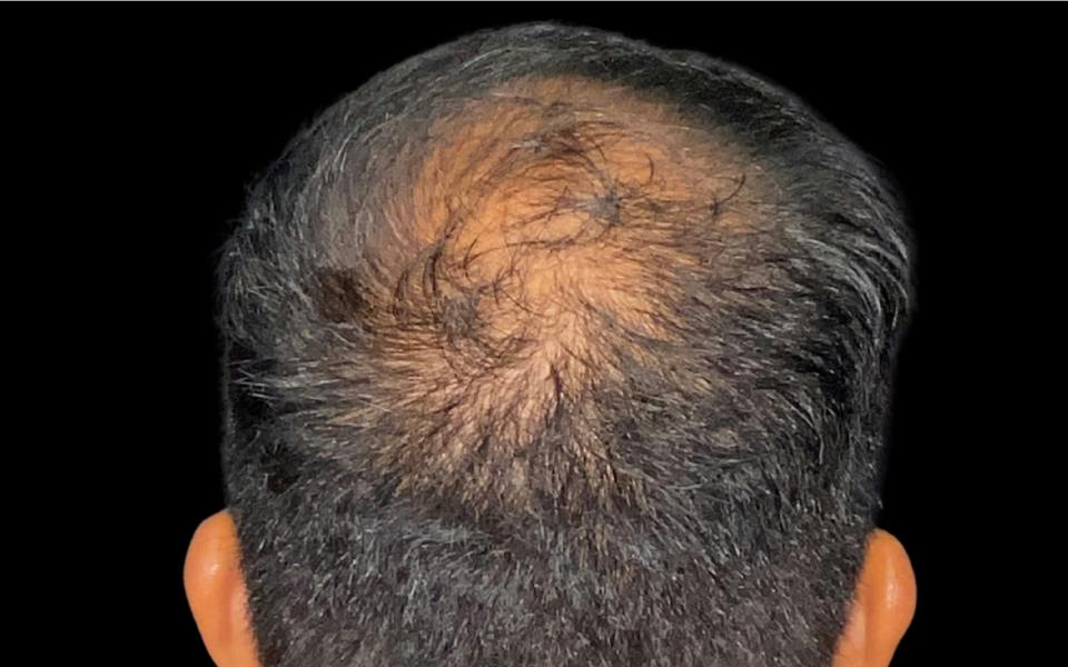 Hair Transplant Hawaii