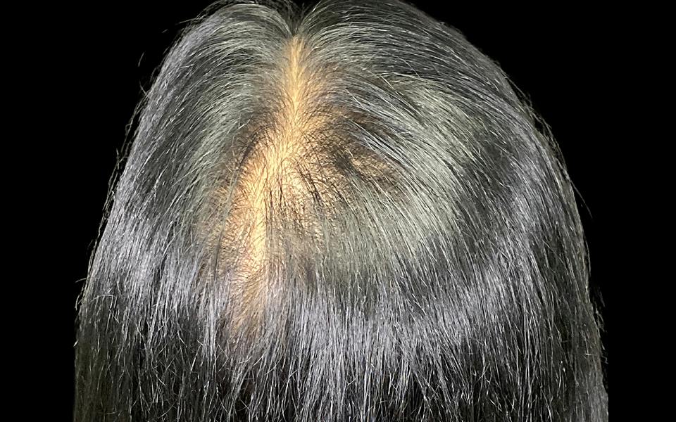 Hair Transplant Hawaii