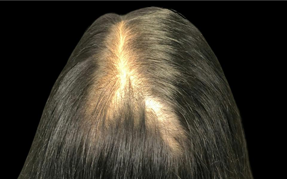 Hair Transplant Hawaii
