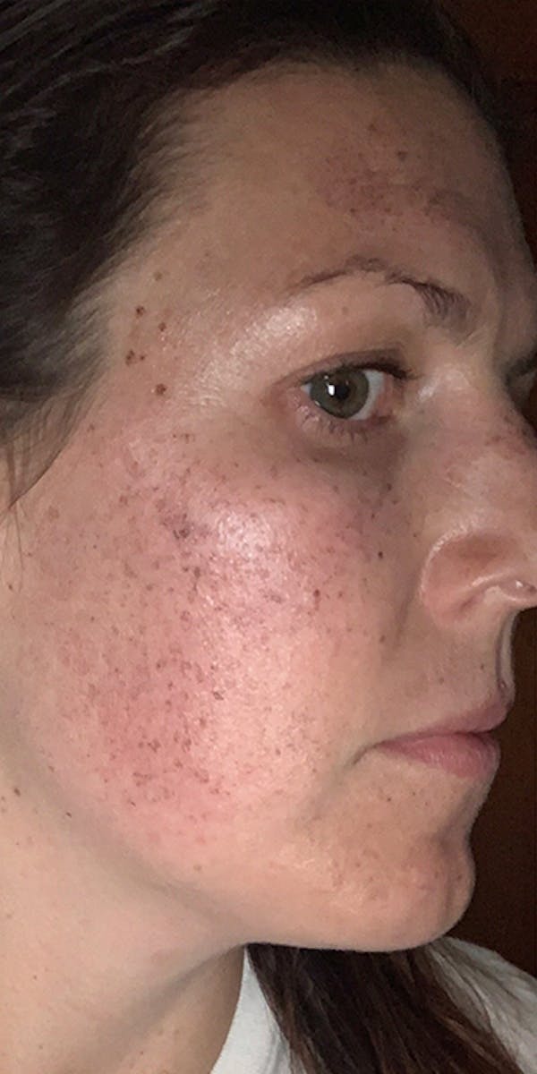 BBL Laser Before & After Gallery - Patient 5646898 - Image 3