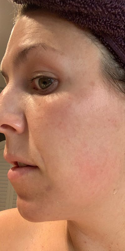 BBL Laser Before & After Gallery - Patient 5646898 - Image 6