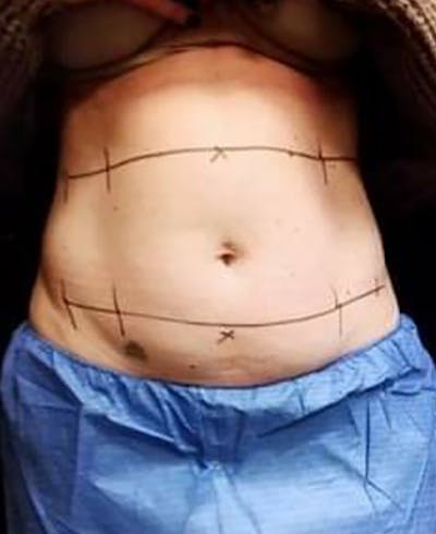 CoolSculpting Before & After Gallery - Patient 5646902 - Image 1