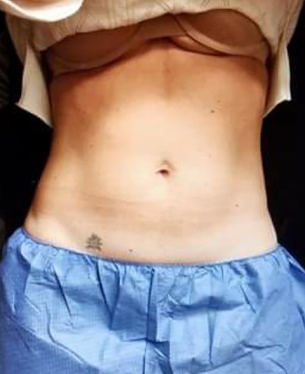 CoolSculpting Before & After Gallery - Patient 5646902 - Image 2