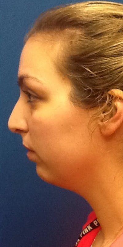 Kybella Before & After Gallery - Patient 5646905 - Image 1
