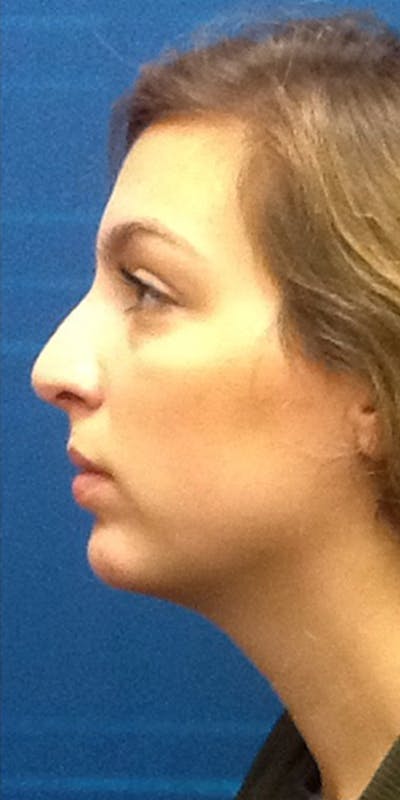 Kybella Before & After Gallery - Patient 5646905 - Image 2