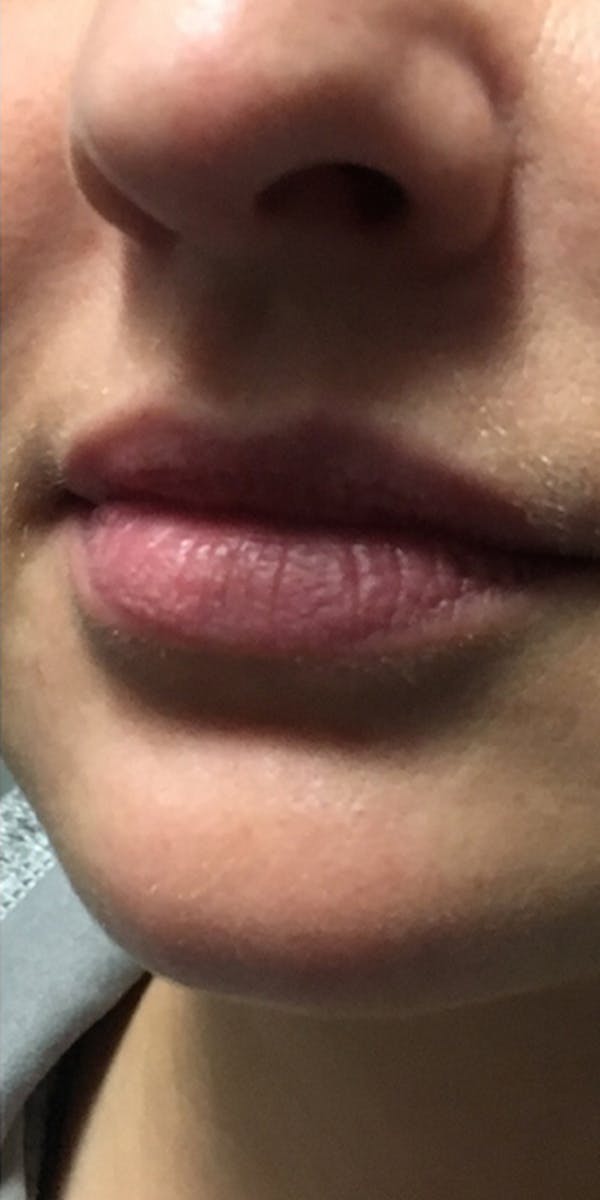 Lip Filler Before & After Gallery - Patient 5646914 - Image 1