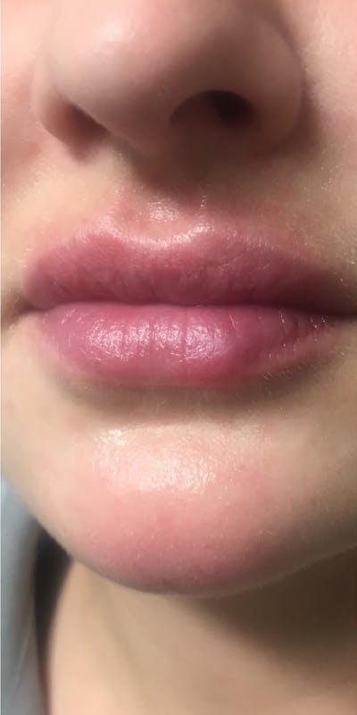 Lip Filler Before & After Gallery - Patient 5646914 - Image 2