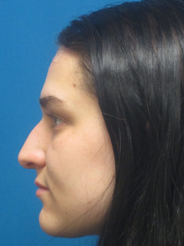 Rhinoplasty/Septoplasty Before & After Gallery - Patient 5646924 - Image 3