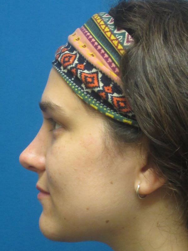 Rhinoplasty/Septoplasty Before & After Gallery - Patient 5646924 - Image 4