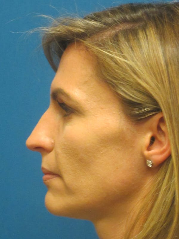 Rhinoplasty/Septoplasty Before & After Gallery - Patient 5646925 - Image 3