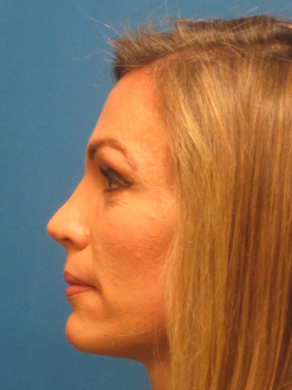 Rhinoplasty/Septoplasty Before & After Gallery - Patient 5646925 - Image 4