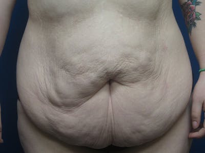 Surgery after Massive Weight Loss Before & After Gallery - Patient 5646936 - Image 1