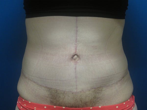 Surgery after Massive Weight Loss Before & After Gallery - Patient 5646936 - Image 2