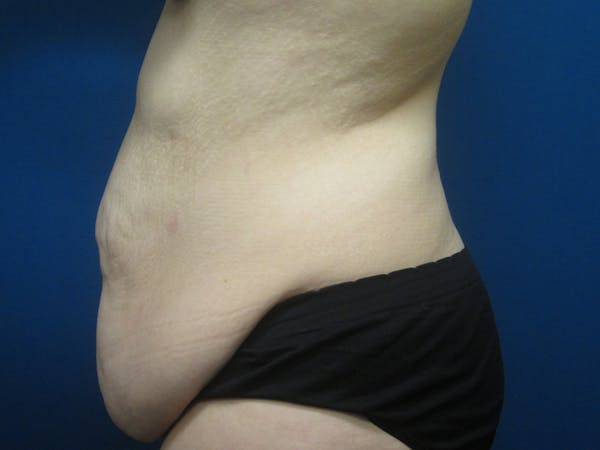 Surgery after Massive Weight Loss Gallery - Patient 5646936 - Image 3