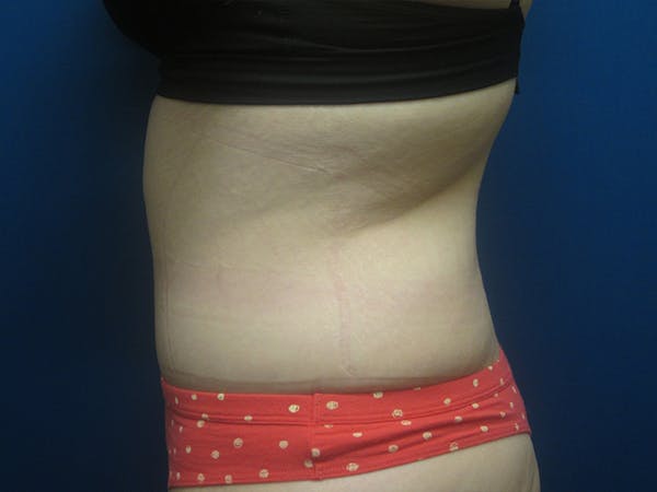 Surgery after Massive Weight Loss Before & After Gallery - Patient 5646936 - Image 4