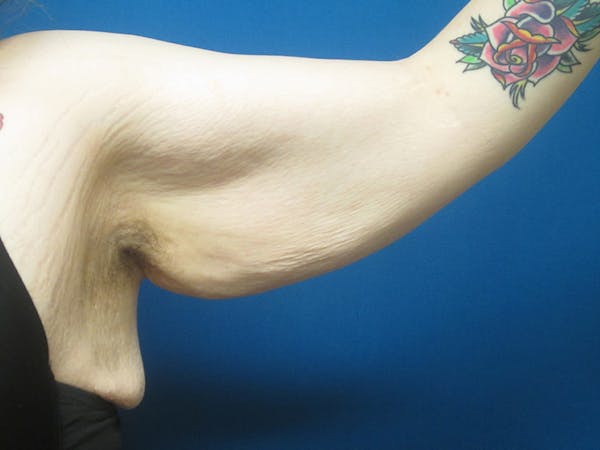 Surgery after Massive Weight Loss Before & After Gallery - Patient 5646936 - Image 5