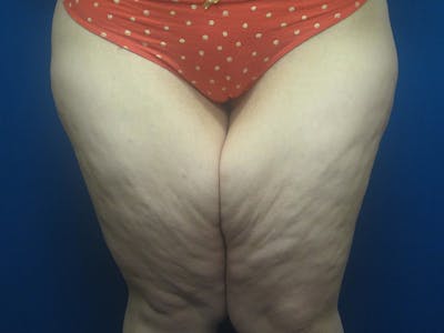 Surgery after Massive Weight Loss Gallery - Patient 5646936 - Image 10