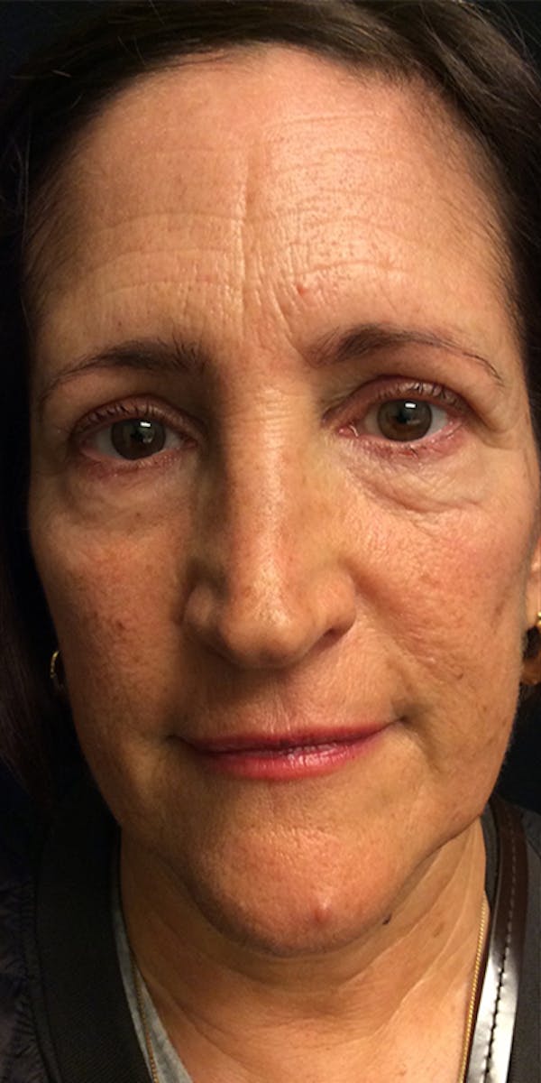 Ultherapy Before & After Gallery - Patient 5646944 - Image 1