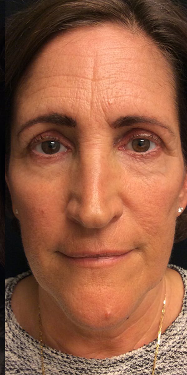 Ultherapy Before & After Gallery - Patient 5646944 - Image 2