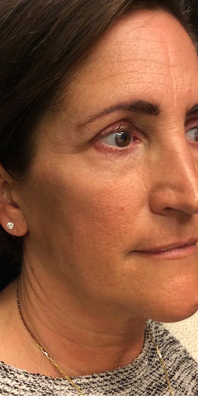 Ultherapy Before & After Gallery - Patient 5646944 - Image 4