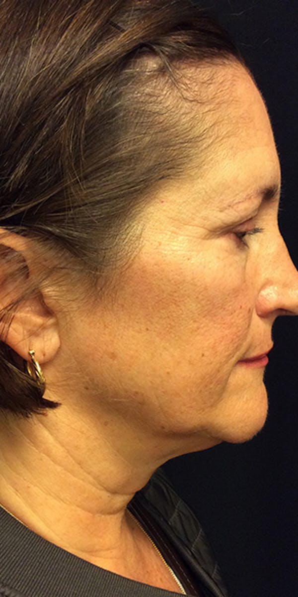 Ultherapy Before & After Gallery - Patient 5646944 - Image 5