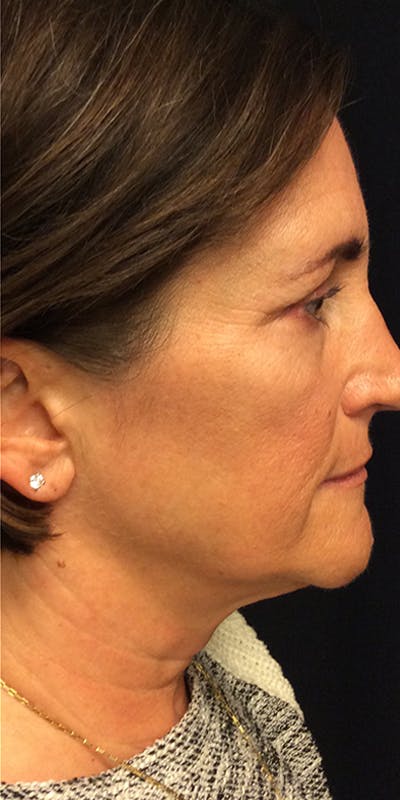Ultherapy Before & After Gallery - Patient 5646944 - Image 6