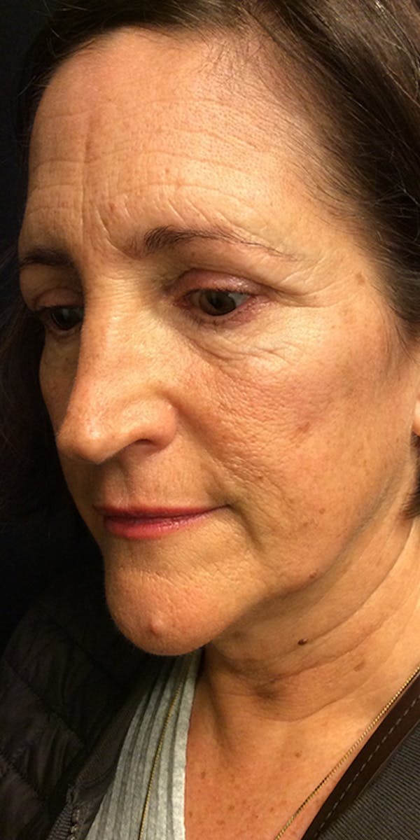 Ultherapy Before & After Gallery - Patient 5646944 - Image 7