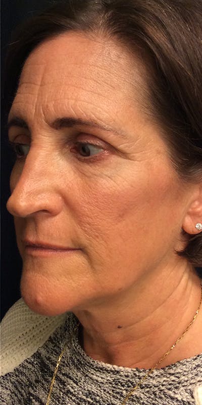 Ultherapy Before & After Gallery - Patient 5646944 - Image 8