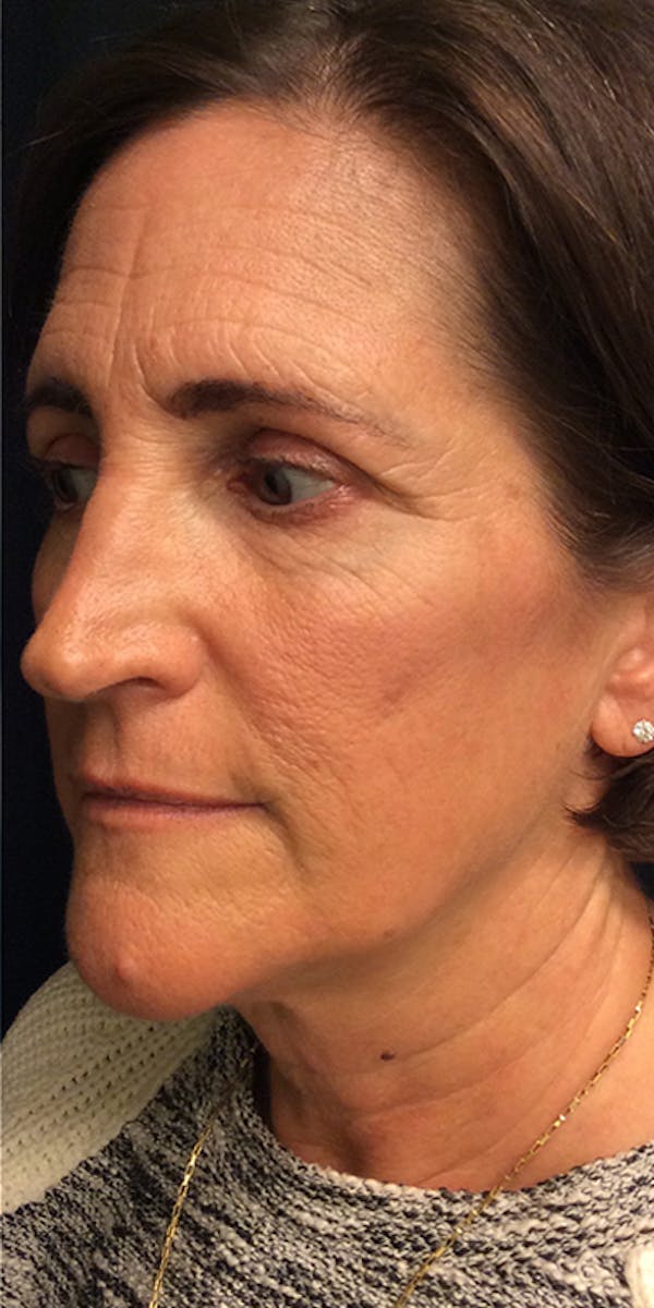Ultherapy Before & After Gallery - Patient 5646944 - Image 8