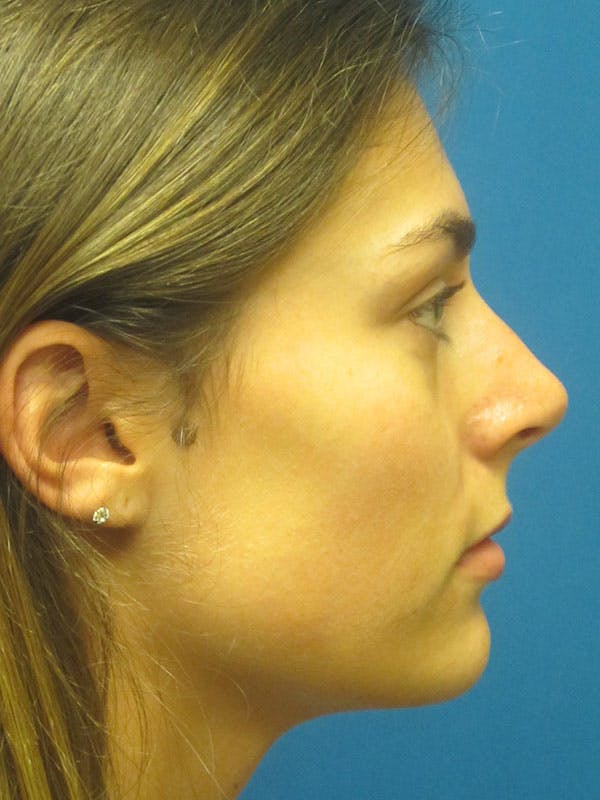 Rhinoplasty/Septoplasty Before & After Gallery - Patient 5804845 - Image 5