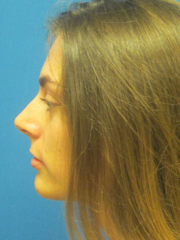 Rhinoplasty/Septoplasty Before & After Gallery - Patient 5804845 - Image 7