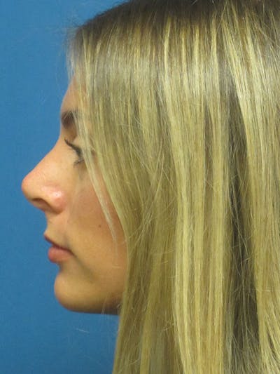 Rhinoplasty/Septoplasty Before & After Gallery - Patient 5804845 - Image 8