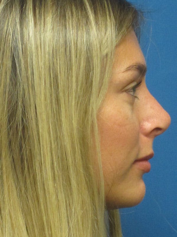 Rhinoplasty/Septoplasty Before & After Gallery - Patient 5804845 - Image 6