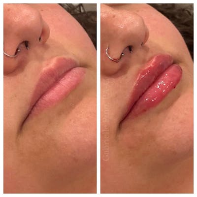 Lip Augmentation Before & After Gallery - Patient 10910414 - Image 1