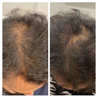 Hair Restoration  Before & After Gallery - Patient 24987372 - Image 1