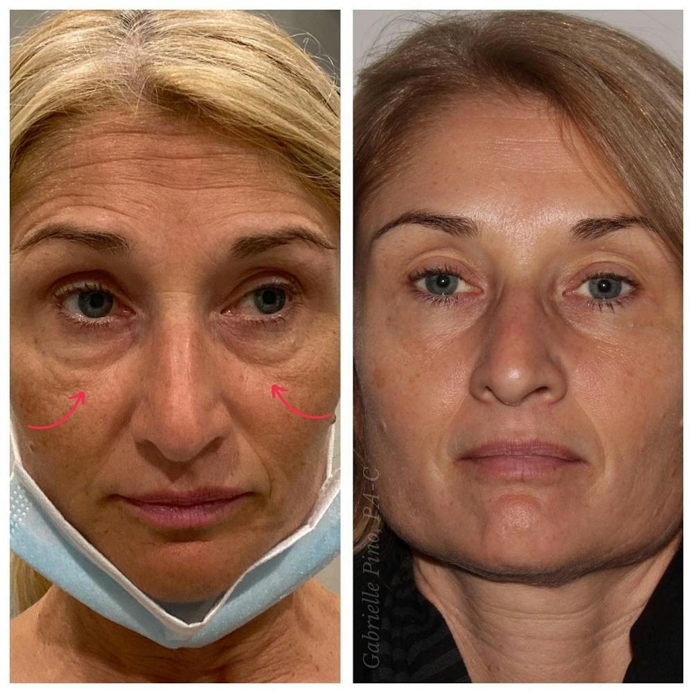 Full Face Rejuvenation Before & After Gallery - Patient 24987377 - Image 1