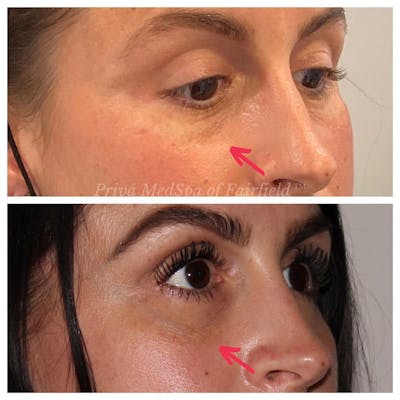 Tear Trough Fillers Before & After Gallery - Patient 24987396 - Image 2