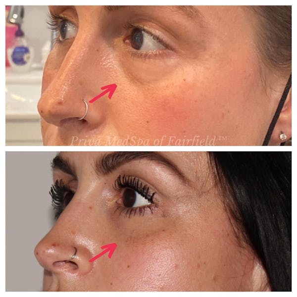 Tear Trough Fillers Before & After Gallery - Patient 24987396 - Image 1