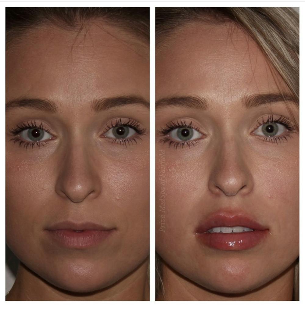Patient 24987426 Lip Augmentation Before And After Photos Gabrielle Pino Pa C