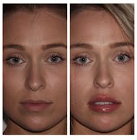 Lip Augmentation Before & After Gallery - Patient 24987426 - Image 1