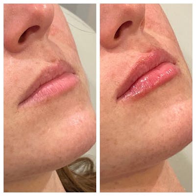Lip Augmentation Before & After Gallery - Patient 24987457 - Image 1