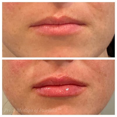 Lip Augmentation Before & After Gallery - Patient 24987457 - Image 2