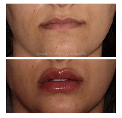 Lip Augmentation Before & After Gallery - Patient 24987459 - Image 1