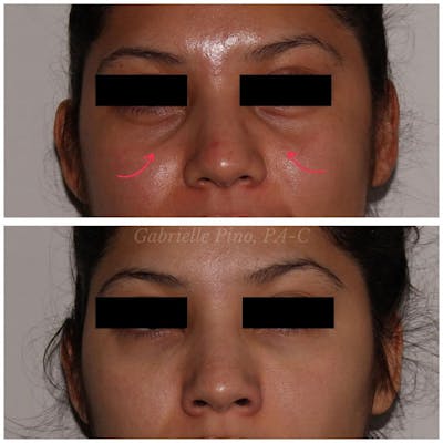 Tear Trough Fillers Gallery - Patient 24987490 - Image 1